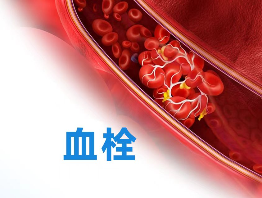 血管哨兵:探索六項關鍵血栓標志物檢測!